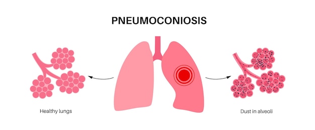 Vector pneumoconiosis lung disease