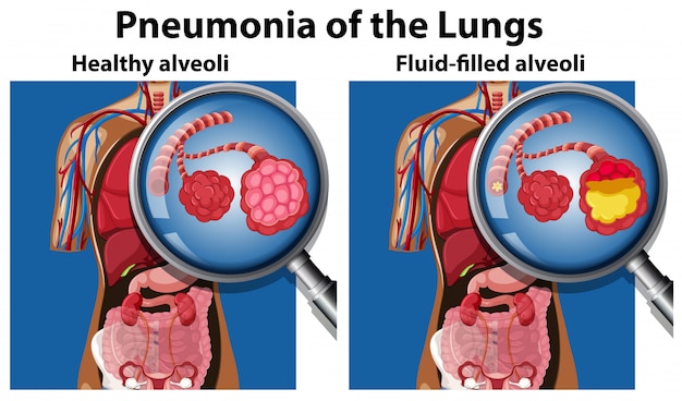 Pneumonia of the lungs concept