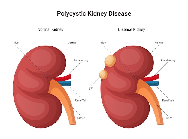 Вектор Инфографика поликистозной болезни почек, иллюстрация дизайна нормальной почки и больной почки