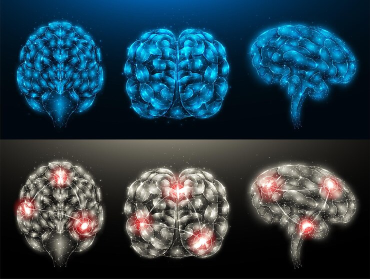Vector polygonal vector illustrations of a healthy brain and a diseased brain with foci of inflammation