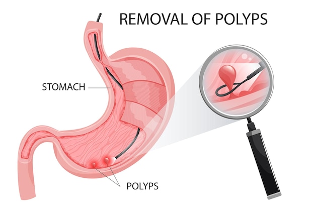Polyp verwijdering procedure in de maag Polyp is onder vergroting Vector illustratie cartoon stijl