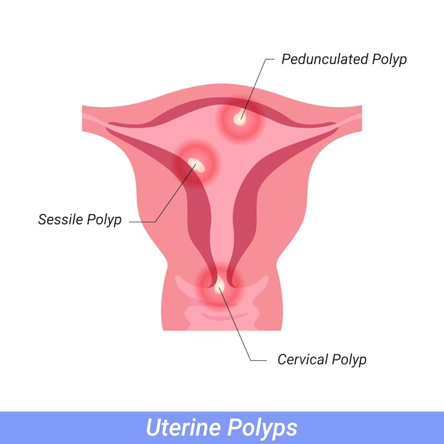 Vector polyps in the uterus female reproductive system human anatomy internal organs