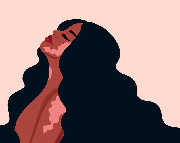 vitiligo와 아름 다운 여자의 초상화입니다. 자기 사랑 개념