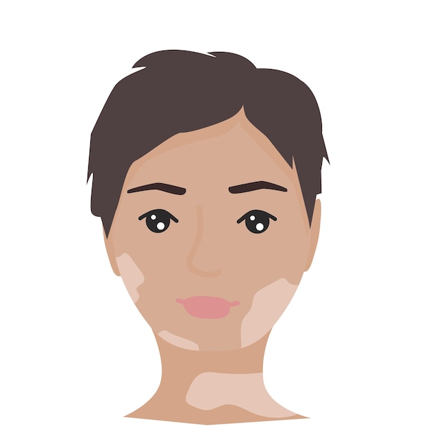 Vector portrait of female with vitiligo self acceptance self love concept world vitiligo day