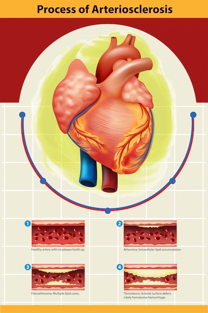 Vettore poster di processo di arteriosclerosi