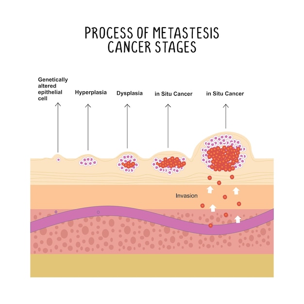 Proces van uitzaaiingen kanker stadia illustratie geïsoleerd op een witte achtergrond