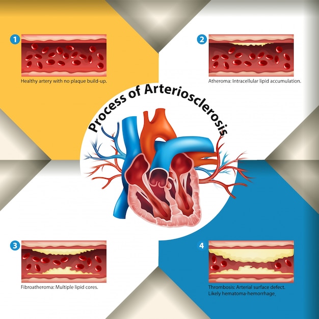 Vector process of arteriosclerosis poster