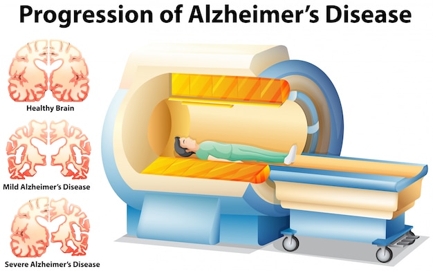 Progressione della malattia di alzheimer