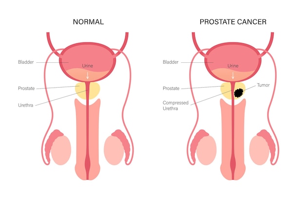 Vector prostate cancer concept