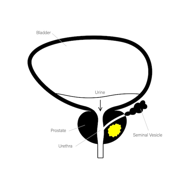 Vector prostate cancer concept