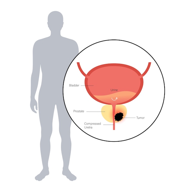 Vector prostate cancer concept