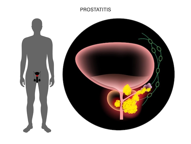 Vector prostate cancer concept