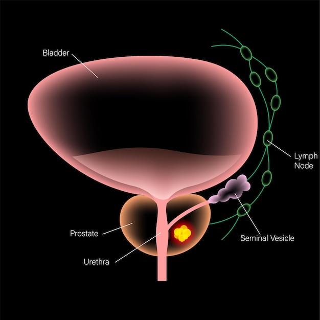 Vector prostate cancer concept