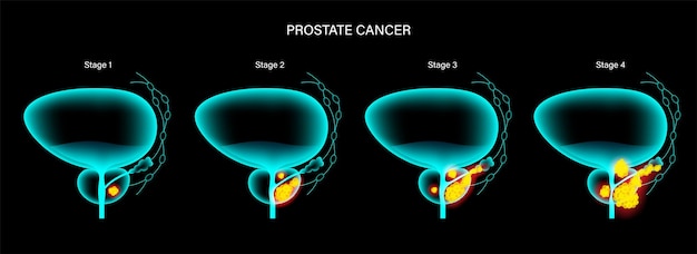 Vector prostate cancer concept