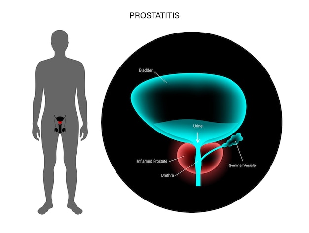 Problema di infiammazione della prostatite