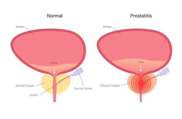 Prostatitis ontstekingsprobleem