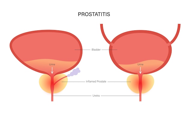 Vector prostatitis ontstekingsprobleem