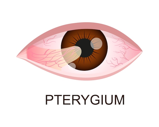 Pterygium groeit op het hoornvlies Conjunctivale degeneratie Oogziekte