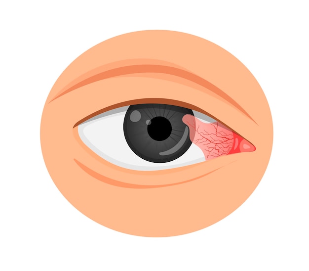 The pterygium grows on the cornea. Eye disease. Cartoon vector illustration.