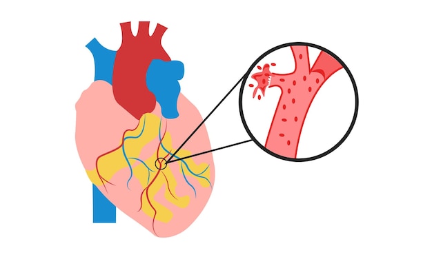 A pulmonary embolism PE is a serious condition that occurs when a blood clot blocks an artery