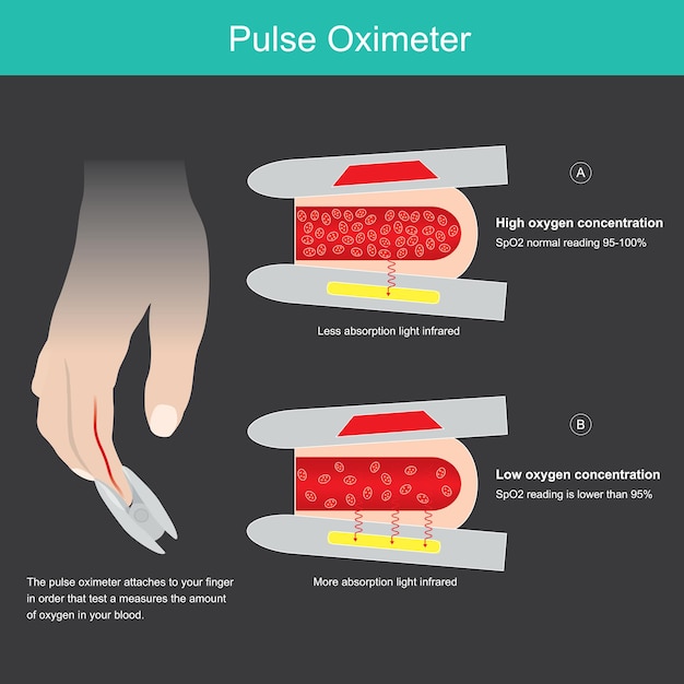 Pulsossimetro. illustrazione per l'apprendimento del dispositivo medico utilizzato per misurare la saturazione di ossigeno nel vaso sanguigno dalla punta del dito.