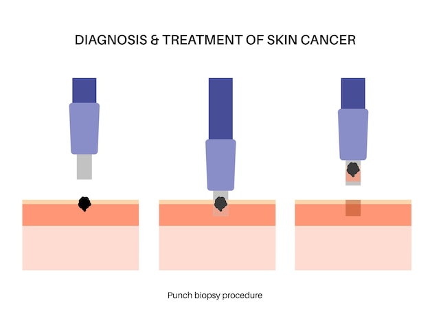 Punch biopsy procedure