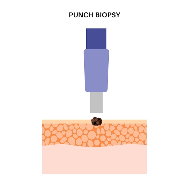 Vector punch biopsy procedure