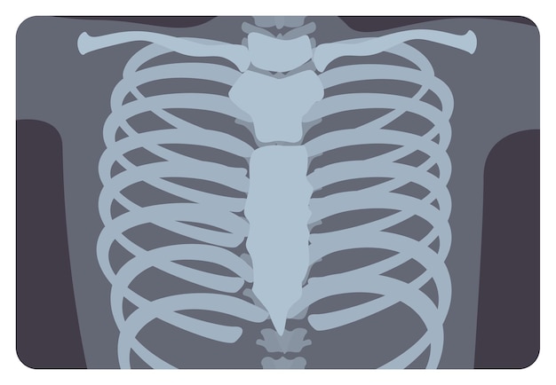 Radiograph, X-radiation picture or X-ray image of rib or thoracic cage formed by vertebral column and sternum. Medical radiography and human skeletal system. Flat monochrome vector illustration.
