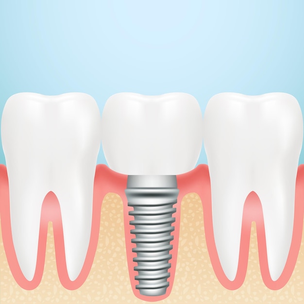 Realistic dental implant installation of dental implant with all parts crown abutment screw isolated on a background vector illustration