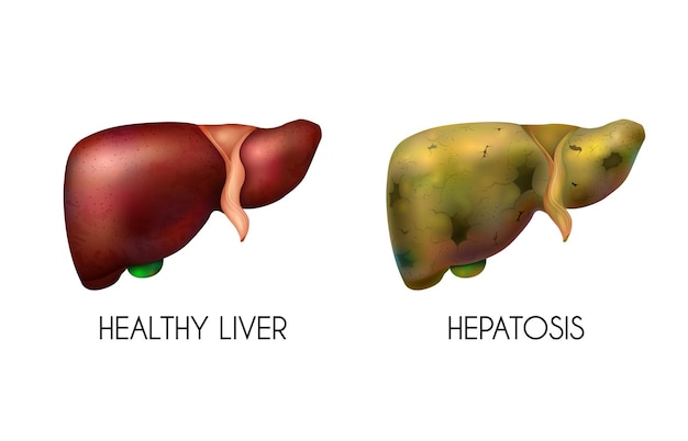 Realistic human internal organs liver healthy normal unhealthy fatty composition with two different colors when the disease is present  illustration