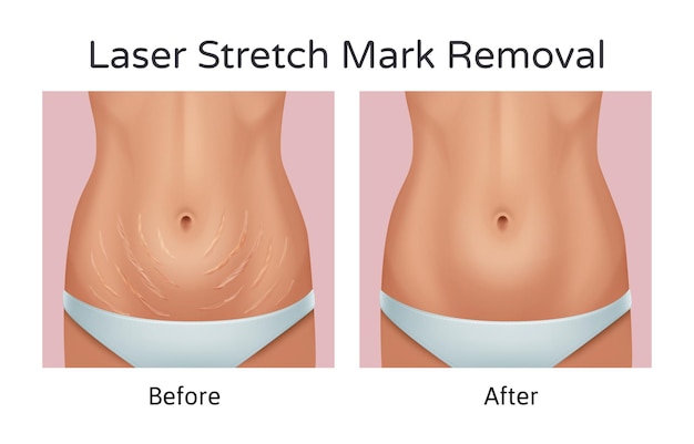 Premium Vector | Realistic illustration of before and after laser  stretchmarks removal