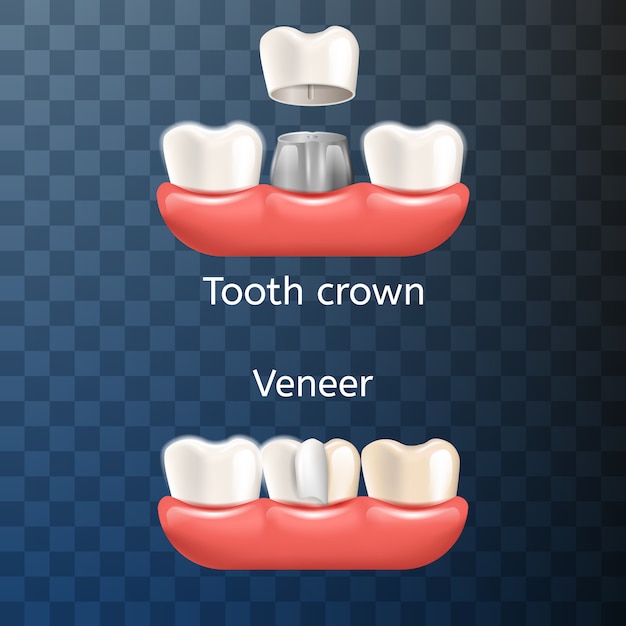 Corona dentale del dente dell'illustrazione realistica, venner