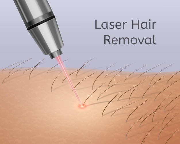 Vettore illustrazione realistica della depilazione laser sulle gambe