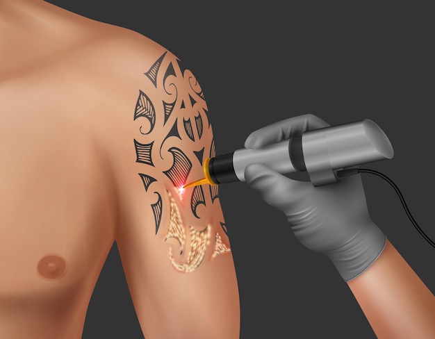 Vettore illustrazione realistica della rimozione del tatuaggio laser sulla spalla dell'uomo