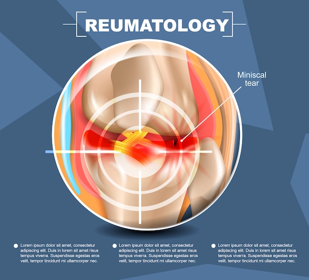 Realistic illustration reumatology medicine in 3d