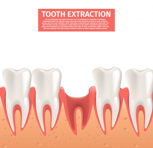 Vettore realistico 3d dell'estrazione del dente dell'illustrazione