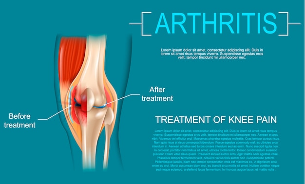 Realistic illustration treatment of knee pain