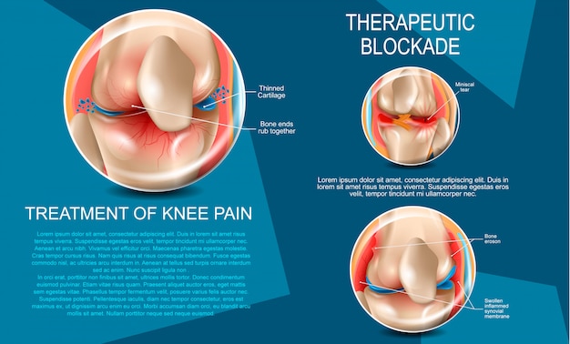 Realistic illustration treatment of knee pain