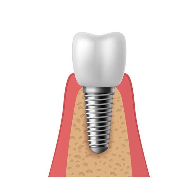 Реалистичный зубной имплантат. 3D зубной протез ортодонтическая имплантация зубов, графические модели структуры имплантата коронка. Вектор концепции протезирования в стоматологической клинике изолирован на белом фоне иллюстрации
