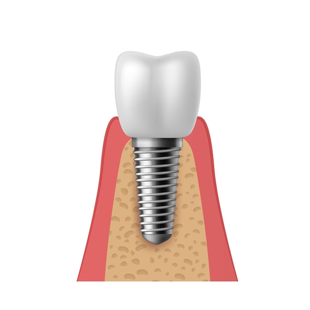 Vector realistic tooth implant. 3d denture orthodontic implantation teeth, implant structure pictorial models crown. prosthetics in stomatology clinic concept vector isolated on white background illustration