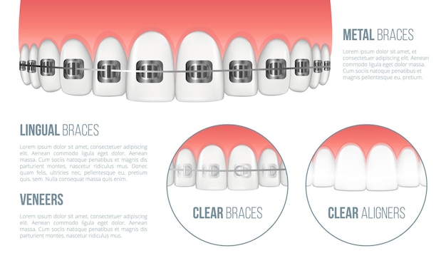 Realistic upper jaw with healthy tooth and dental braces metal lingual clear aligners