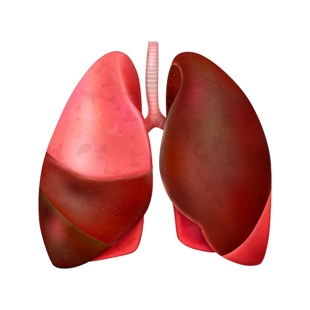 손상된 폐에 대한 격리된 삽화가 있는 현실적인 세계 폐렴의 날 구성