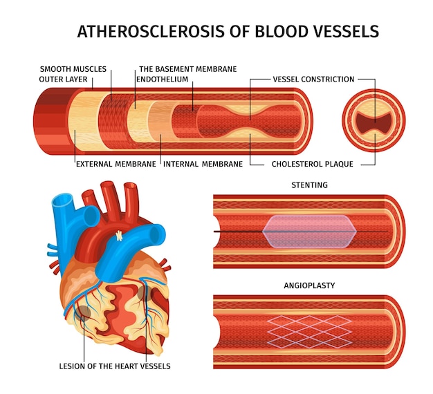 Vector realistische atherosclerose infographic met stenting angioplastiek beschrijvingen gladde spieren buitenste laag het basaalmembraan endotheel externe en interne membranen en cholesterol plaque beschrijving