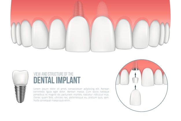 Realistische bovenkaak met gezonde tand en tandimplantaat Schema met de installatie