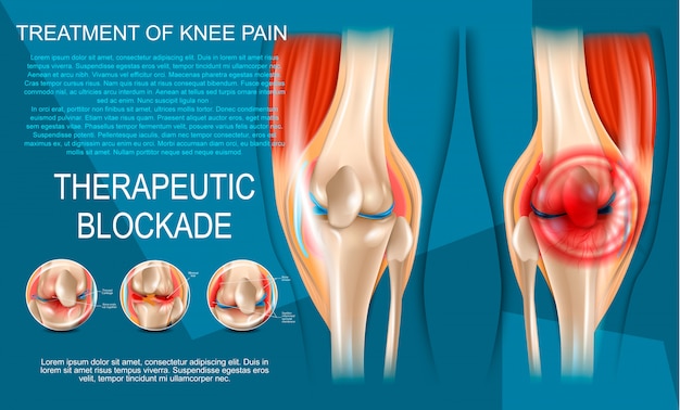 Realistische illustratie Behandeling van kniepijn