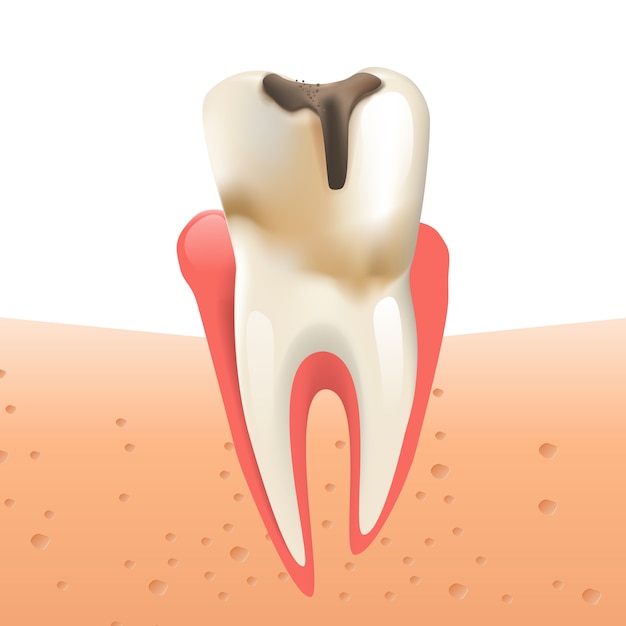 Realistische illustratie glazuur Cariës in 3d Vector