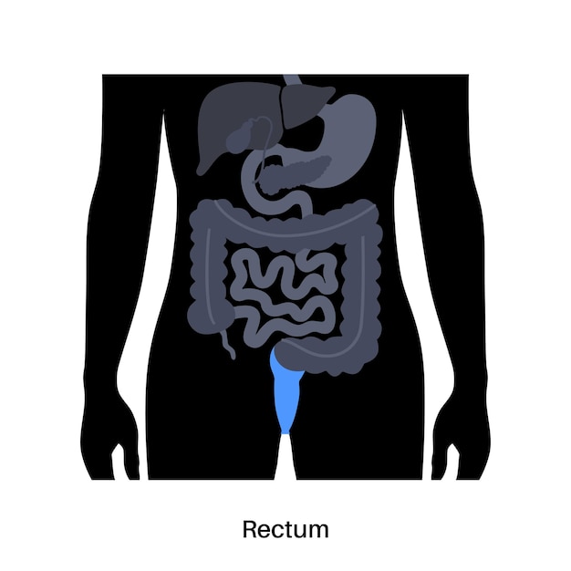 Rectum colon poster Large intestine in the human body Gastrointestinal disease diagnostic and treatment in gastroenterology clinic Digestive tract examination of bowel vector illustration