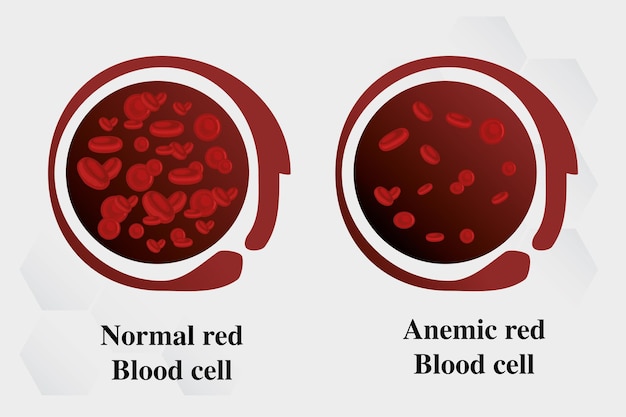 Vettore globuli rossi anemia da carenza di ferro differenza tra quantità di anemia e vettore di sintomi normali