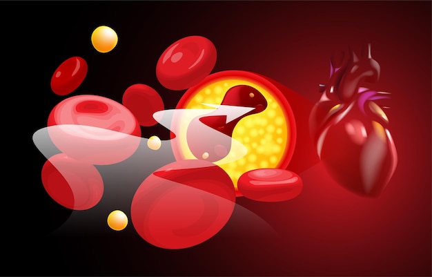 Vector red blood cells and cholesterol clog before the heart