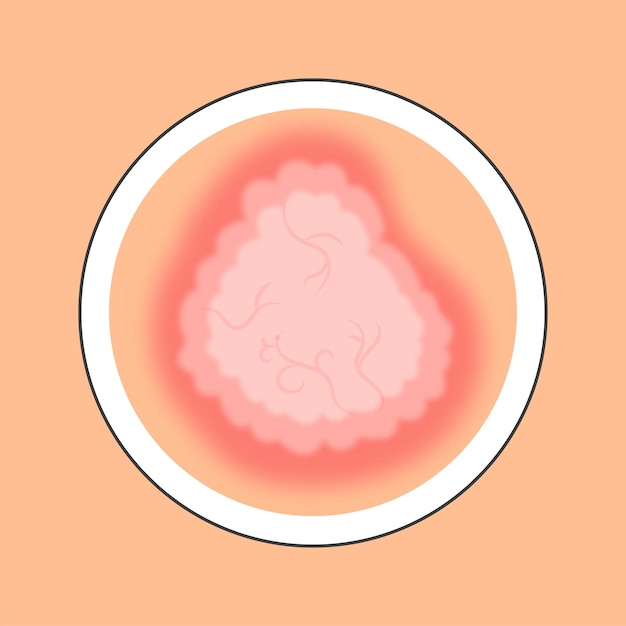 Red And Peach Warts Disease Skin Circle Icon In Flat Style